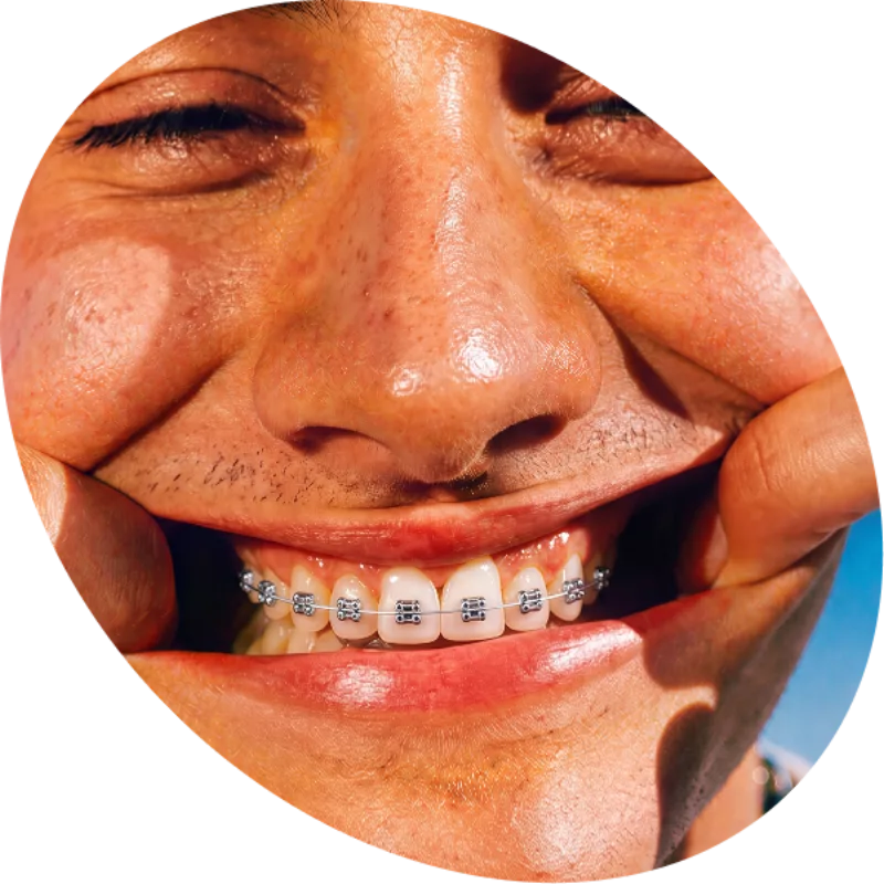 Braces